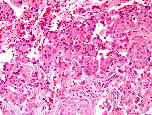 12A Meningioma (Case 12) H&E 1.jpg