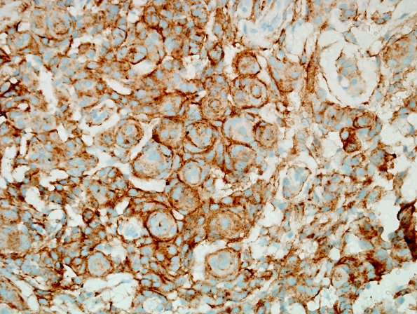 12B1 Meningioma (Case 12) EMA 1.jpg