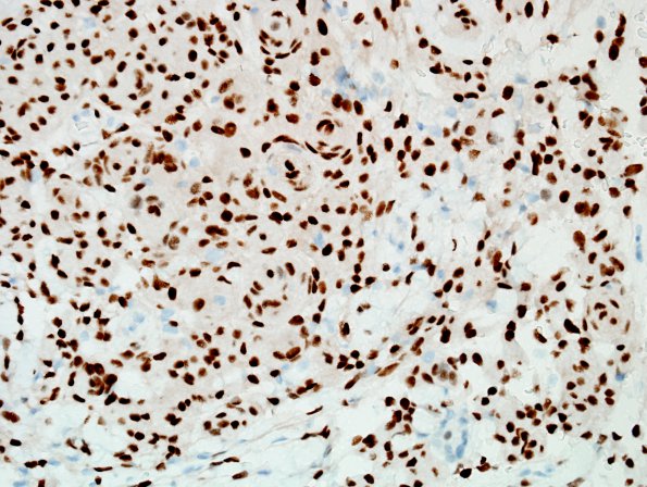 12C Meningioma (Case 12) PR.jpg