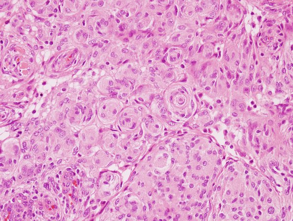 13A1 Meningioma (Case 13) 1