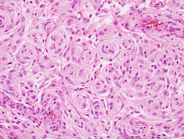 13A2 Meningioma (Case 13) 2