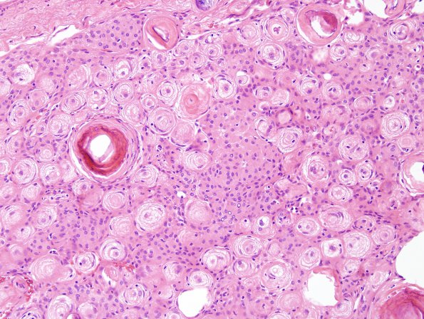 14A Meningioma (Case 14) H&E 9