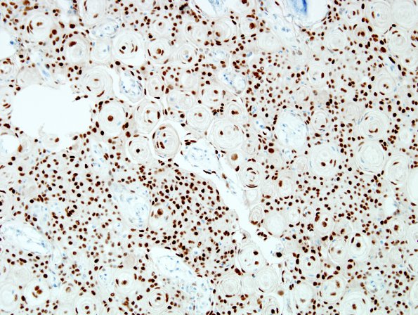 14B1 Meningioma (Case 14) PR 3