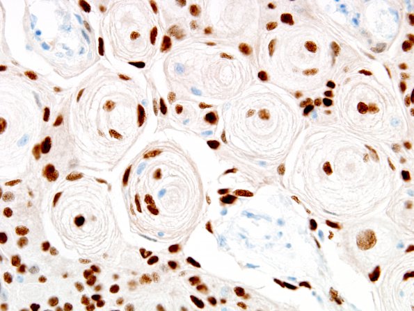 14B2 Meningioma (Case 14) PR 5