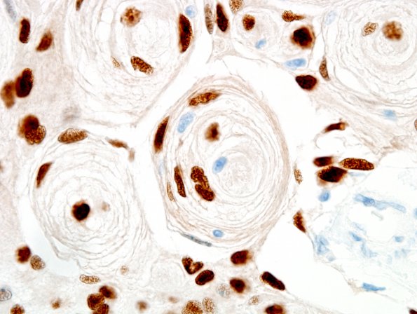 14B3 Meningioma (Case 14) PR 7