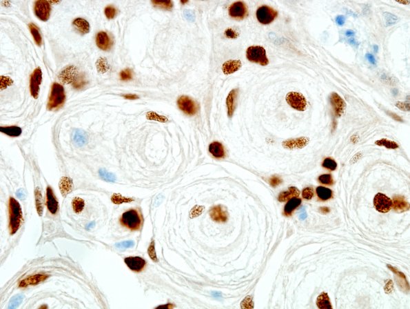 14B4 Meningioma (Case 14) PR 8