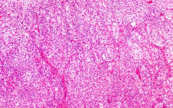 1A1 Meningioma, transitional (Case 1) A7 H&E 10X