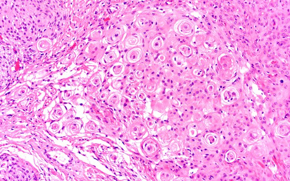 1A2 Meningioma, transitional (Case 1) H&E 20X