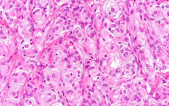 1A3 Meningioma, transitional (Case 1) H&E 40X