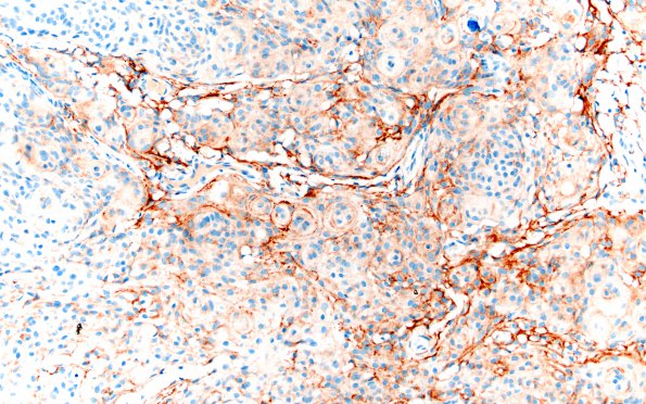 1B1 Meningioma, transitional (Case 1) A4 EMA 20X 2