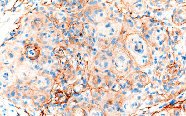 1B2 Meningioma, transitional (Case 1) A4 EMA 40X 1