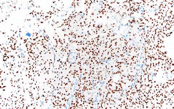 1C Meningioma, transitional (Case 1) A4 PR 20X