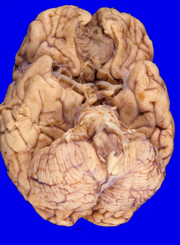 2A1 Meningioma (Case 2)