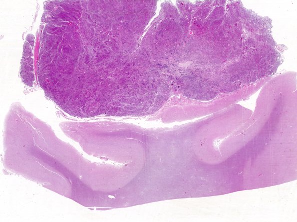 2B1 Meningioma (Case 2) H&E WM