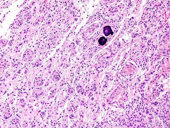 2B3 Meningioma (Case 2) H&E 2