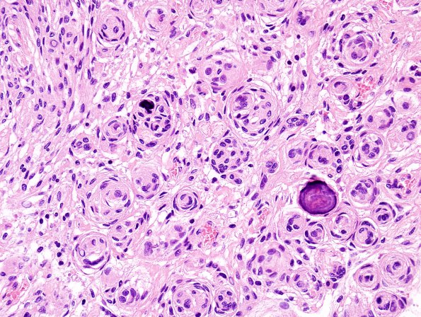 2B4 Meningioma (Case 2) H&E 5