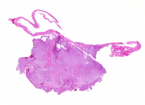 3A1 Meningioma (Case 3) H&E whole mount