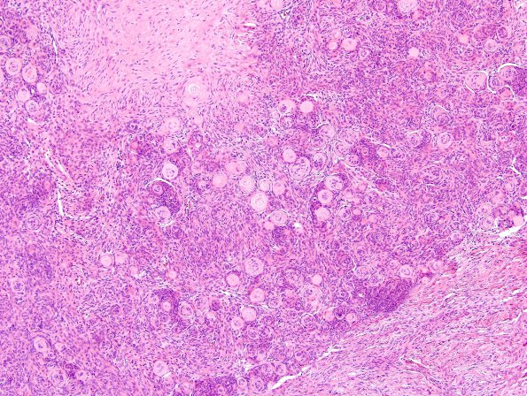 3A2 Meningioma (Case 3) H&E 5