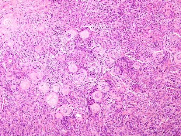 3A3 Meningioma (Case 3) H&E 4