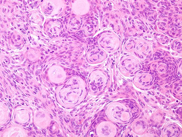 3A4 Meningioma (Case 3) H&E 3