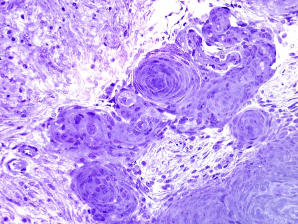 3B1 Meningioma (Case 3) Plastic 40X 1A