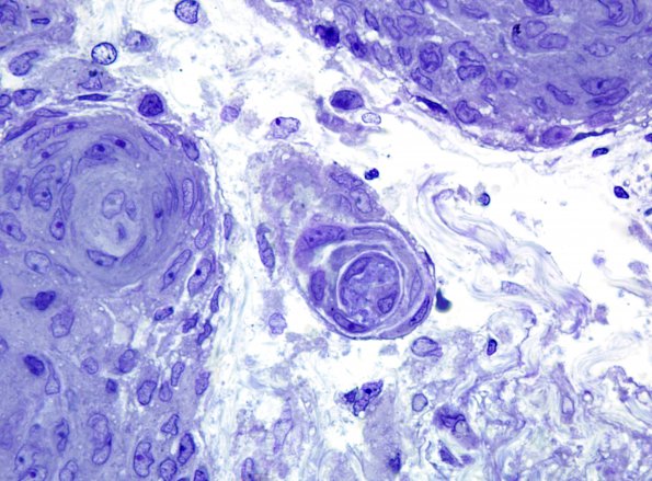 3B2 Meningioma (Case 3) Plastic 100X 1