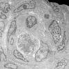 3C Meningioma (Case 3) EM 2 - Copy (2)