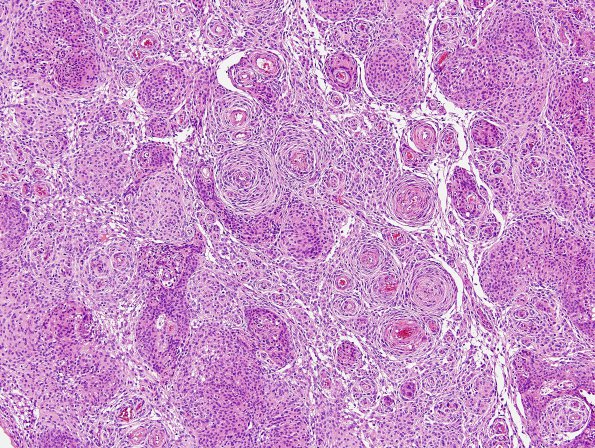 4A1 Meningioma (Case 4) H&E 2