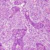 4A2 Meningioma (Case 4) H&E 1