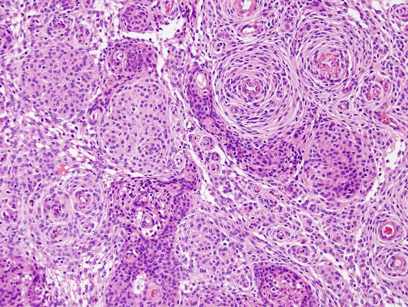 4A2 Meningioma (Case 4) H&E 1