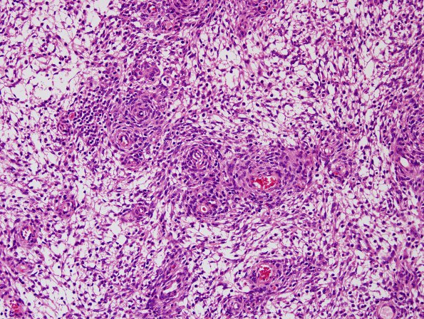 4A3 Meningioma (Case 4) H&E 4