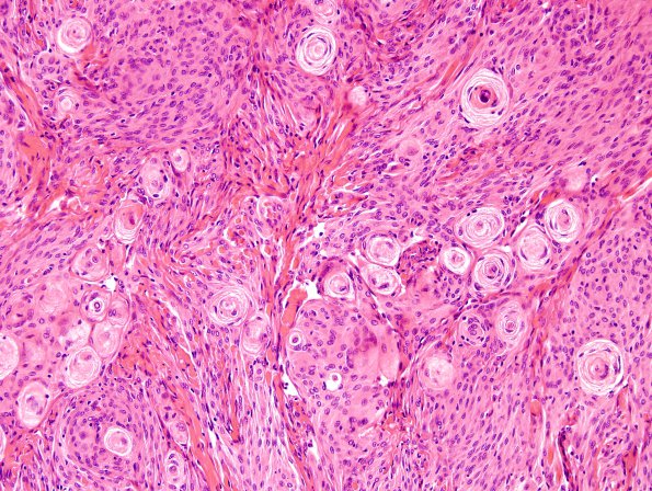 5A1 Meningioma (Case 5) H&E 3