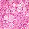 5A2 Meningioma (Case 5) H&E 2