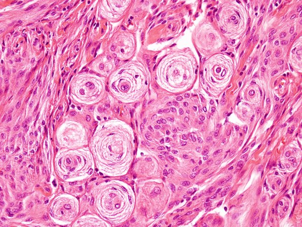 5A2 Meningioma (Case 5) H&E 2