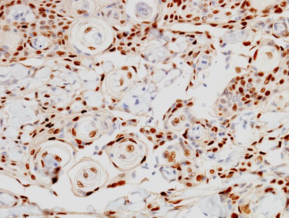 5B2 Meningioma (Case 5) PR 3