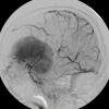 6A1 Meningioma, transitional (Case 6) Angio RCCA 1 - Copy