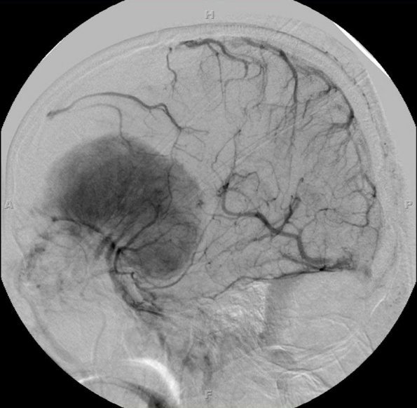 6A1 Meningioma, transitional (Case 6) Angio RCCA 1 - Copy