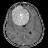 6A2 Meningioma, transitional (Case 6) T1 2 - Copy