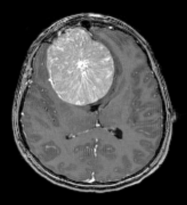 6A2 Meningioma, transitional (Case 6) T1 2 - Copy