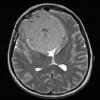 6A3 Meningioma, transitional (Case 6) T2 - Copy