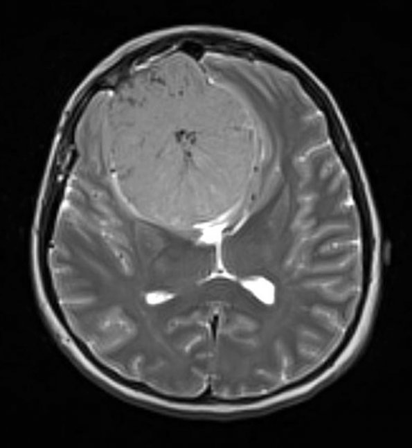 6A3 Meningioma, transitional (Case 6) T2 - Copy