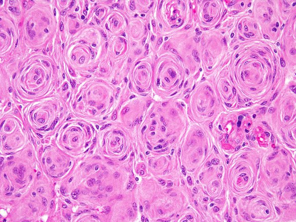 6B2 Meningioma, transitional (Case 6) 4.jpg