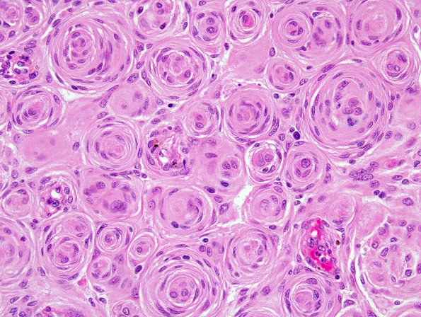 6B3 Meningioma, transitional (Case 6) 2.jpg