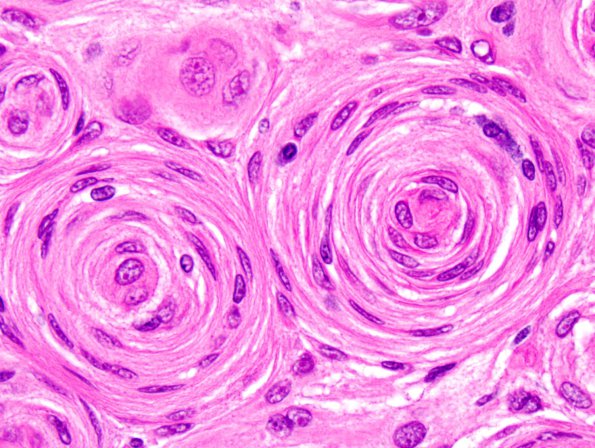 6B4 Meningioma, transitional (Case 6) 3.jpg