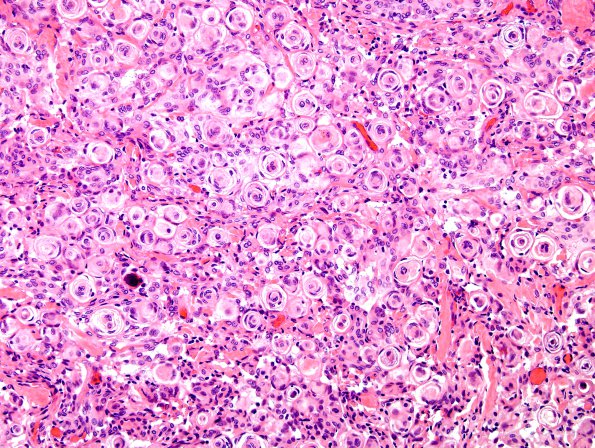 7A1 Meningioma (WHO I, Case 7) H&E 1