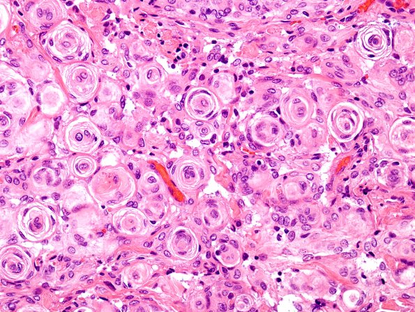 7A2 Meningioma (WHO I, Case 7) H&E 2