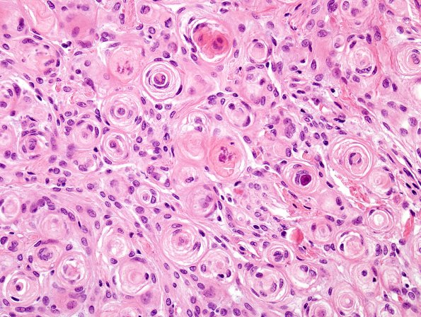 7A3 Meningioma (WHO I, Case 7) H&E 4