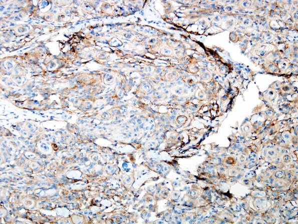 7B1 Meningioma (WHO I, Case 7) EMA 1