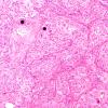 8A1 Meningioma, WHO I whorls (Case 8) H&E 2