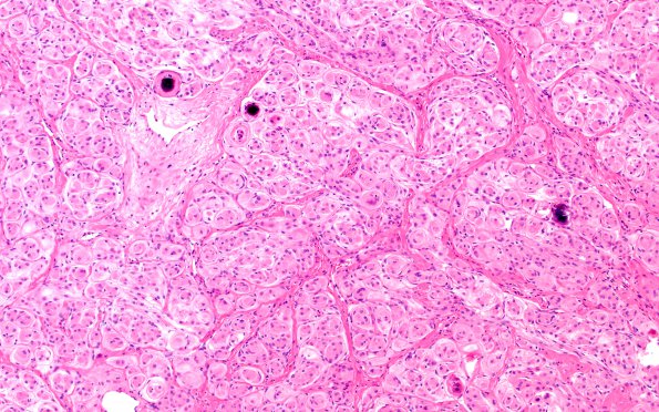 8A1 Meningioma, WHO I whorls (Case 8) H&E 2